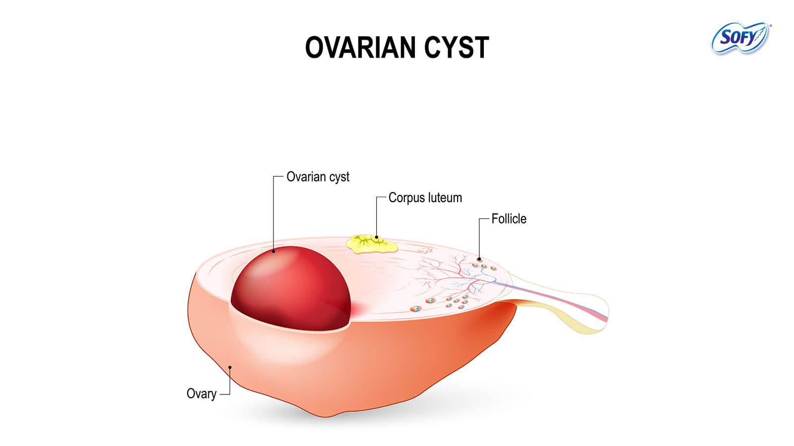 What is PCOD? How it affects your menstrual cycle